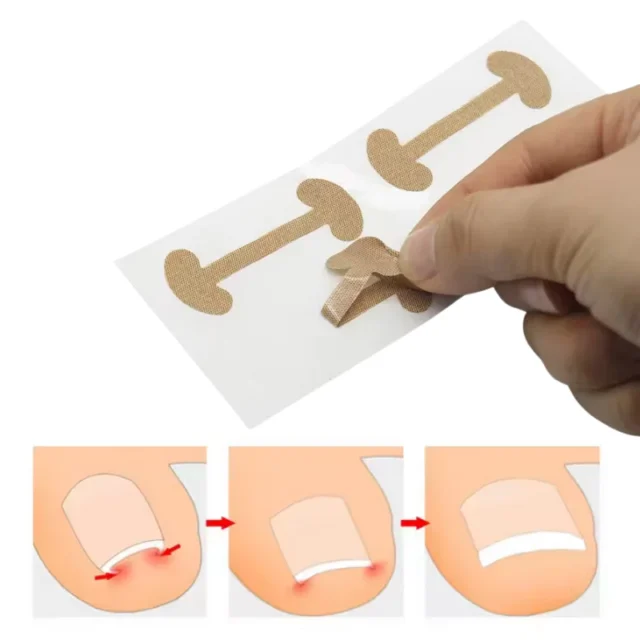 FOOTLOVE Paski na wrastające paznokcie N66 4 sztuki