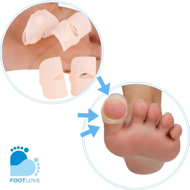 FOOTLOVE Nakładki silikonowe na wrastający paznokieć N75 2 sztuki