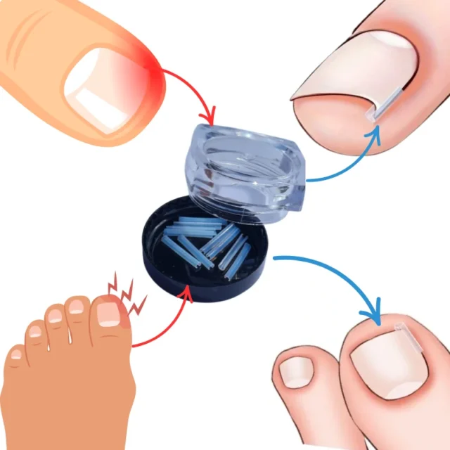 FOOTLOVE Paski ochronne na wrastające paznokcie N92 10 sztuk